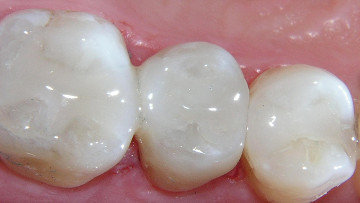 Cavities and the Use of Tooth-Colored Fillings, Dental Services